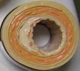 Fatty Plaque Buildup
