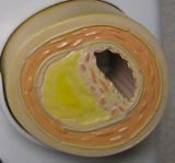 Narrowed Artery
